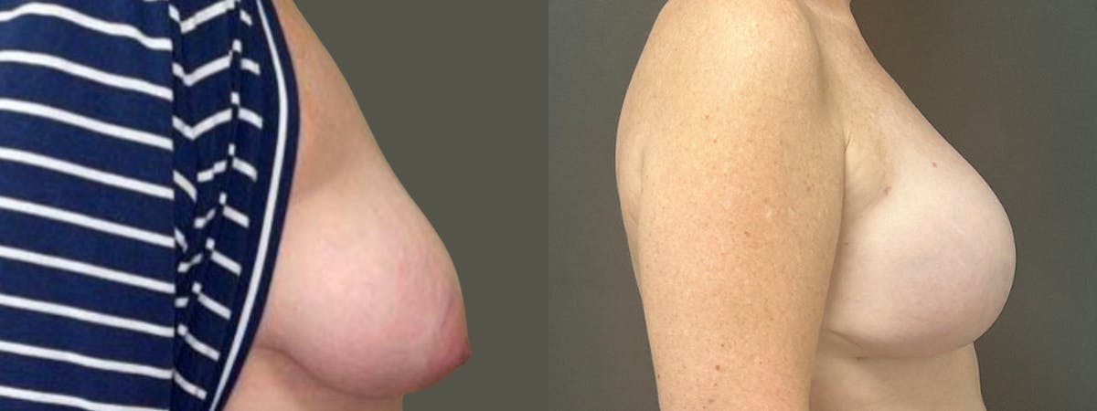 Breast Reconstruction Before & After Gallery - Patient 749061 - Image 3