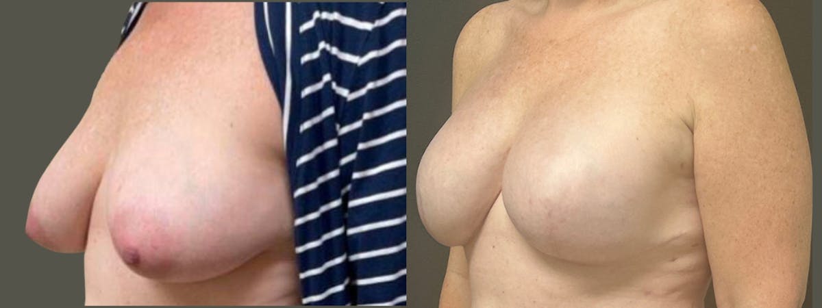 Breast Reconstruction Before & After Gallery - Patient 749061 - Image 4