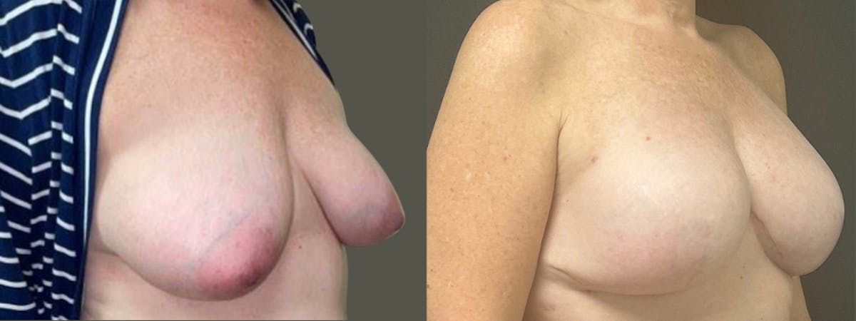 Breast Reconstruction Before & After Gallery - Patient 749061 - Image 2