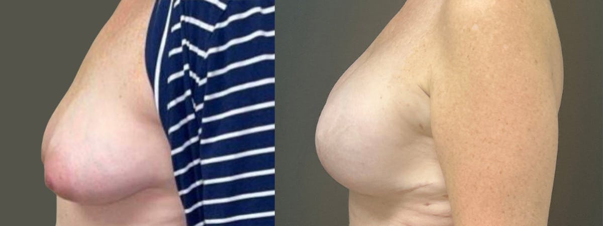 Breast Reconstruction Before & After Gallery - Patient 749061 - Image 5