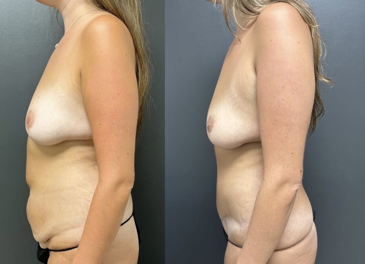 Abdominoplasty (Tummy Tuck) Before & After Gallery - Patient 287633 - Image 3