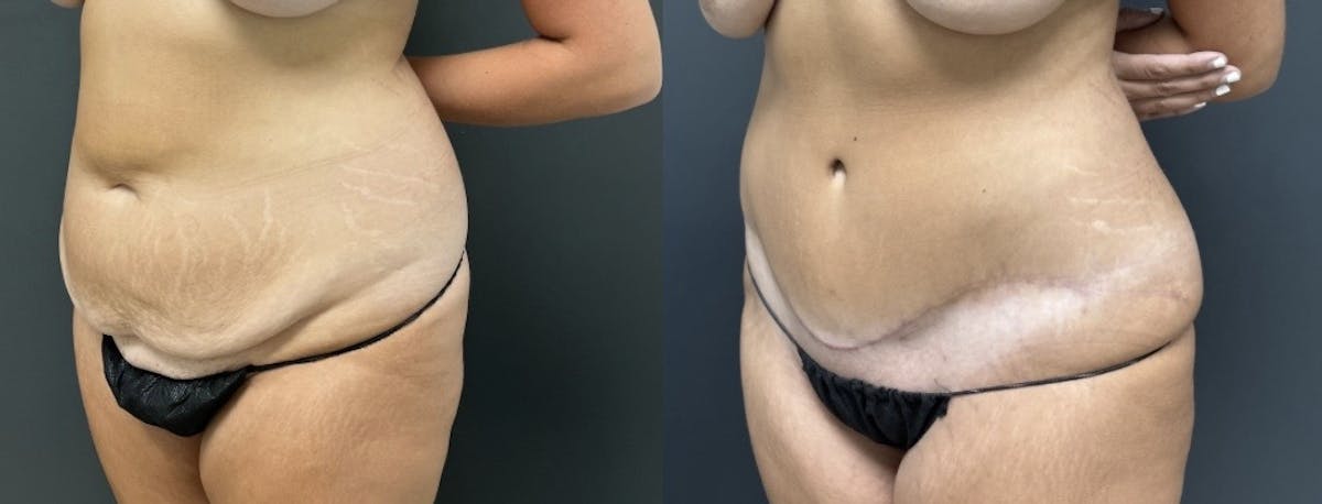 Abdominoplasty (Tummy Tuck) Before & After Gallery - Patient 287633 - Image 2