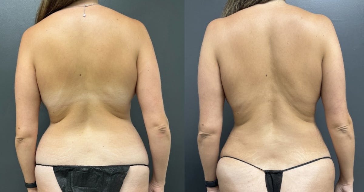 Back Before & After Gallery - Patient 104396 - Image 1