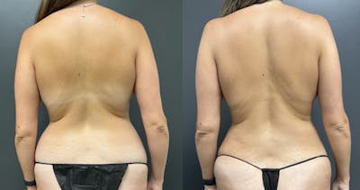 Abdomen Before & After Gallery - Patient 648968 - Image 1