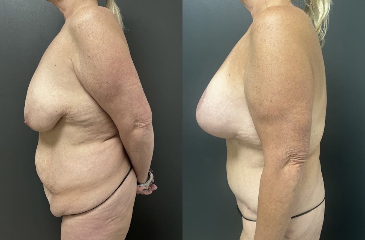 Fleur De Lis Abdominoplasty Before & After Gallery - Patient 362728 - Image 3