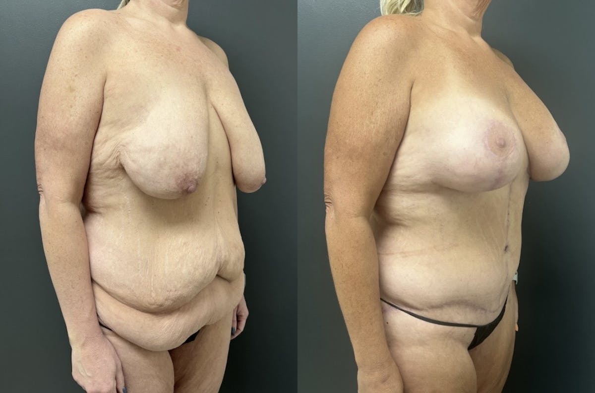 Fleur De Lis Abdominoplasty Before & After Gallery - Patient 362728 - Image 2