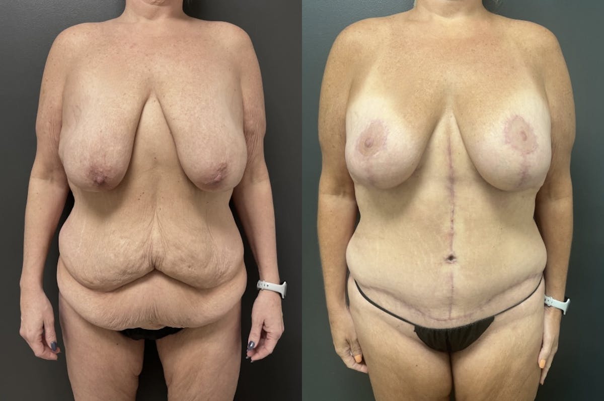 Fleur De Lis Abdominoplasty Before & After Gallery - Patient 362728 - Image 1