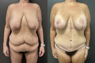 Fleur De Lis Abdominoplasty Before & After Gallery - Patient 362728 - Image 1