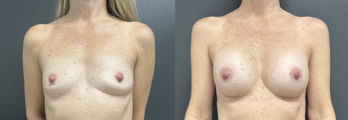 Breast Augmentation Before & After Gallery - Patient 325907 - Image 1