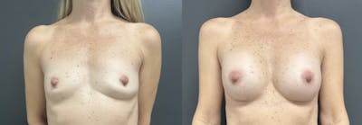Breast Augmentation Before & After Gallery - Patient 325907 - Image 1