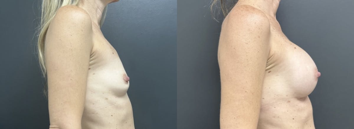 Breast Augmentation Before & After Gallery - Patient 325907 - Image 3