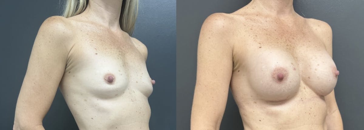 Breast Augmentation Before & After Gallery - Patient 325907 - Image 2