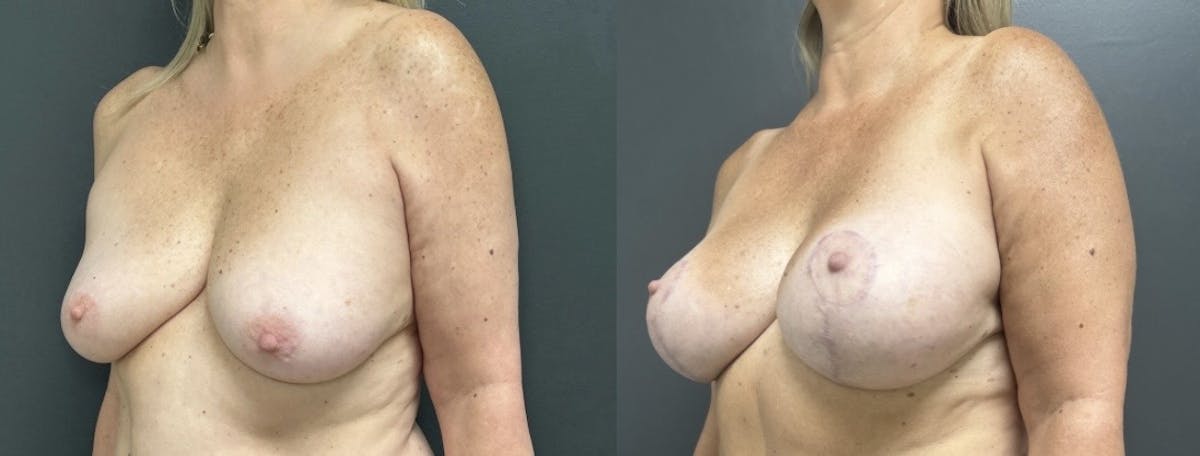 Breast Augmentation with Lift Before & After Gallery - Patient 307788 - Image 2