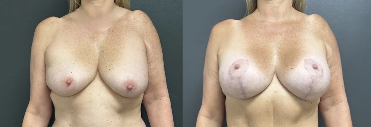 Breast Augmentation with Lift Before & After Gallery - Patient 307788 - Image 1
