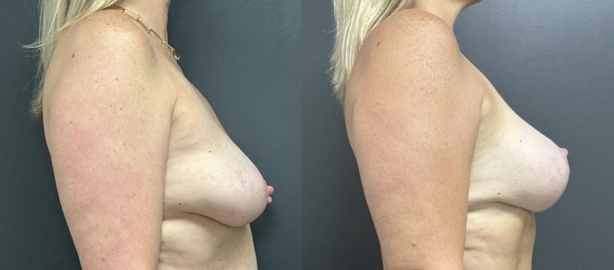 Breast Augmentation with Lift Before & After Gallery - Patient 307788 - Image 3