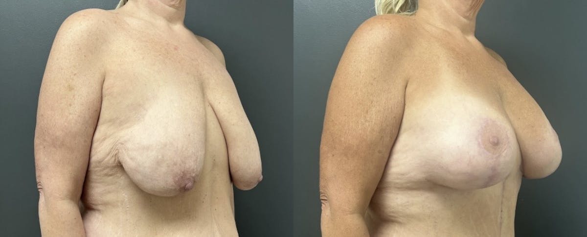 Breast Augmentation with Lift Before & After Gallery - Patient 216710 - Image 2
