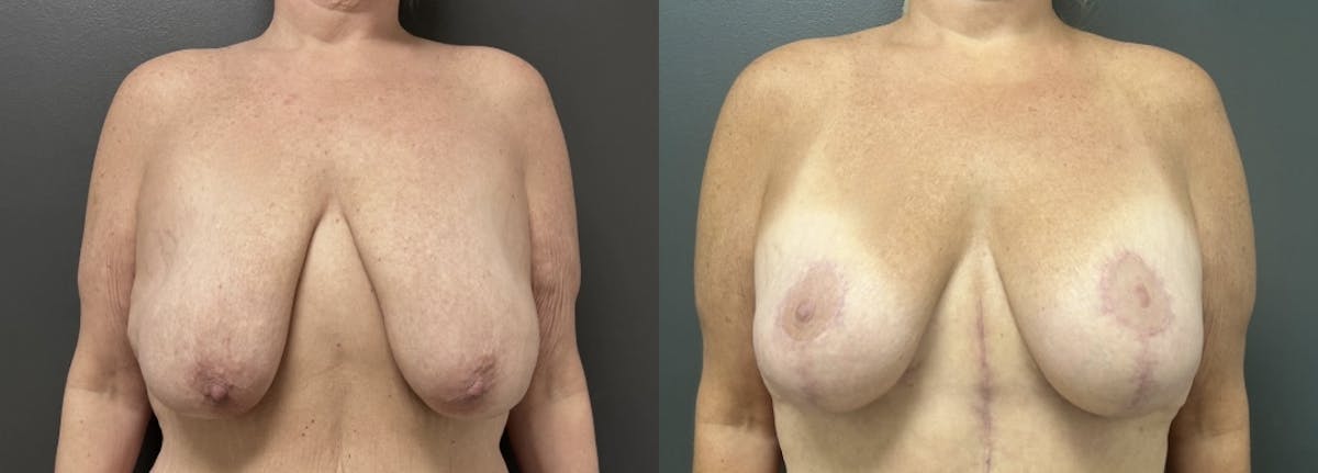 Breast Augmentation with Lift Before & After Gallery - Patient 216710 - Image 1