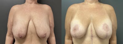 Breast Augmentation with Lift Before & After Gallery - Patient 216710 - Image 1