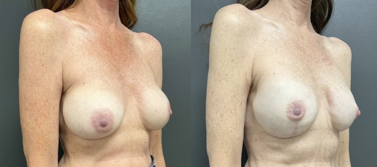 Breast Reconstruction Before & After Gallery - Patient 476487 - Image 2