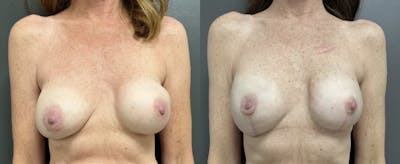 Breast Reconstruction Before & After Gallery - Patient 476487 - Image 1