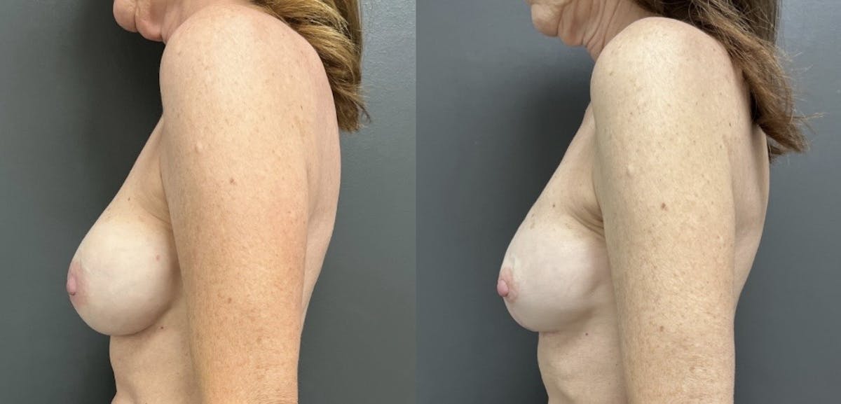 Breast Reconstruction Before & After Gallery - Patient 476487 - Image 3