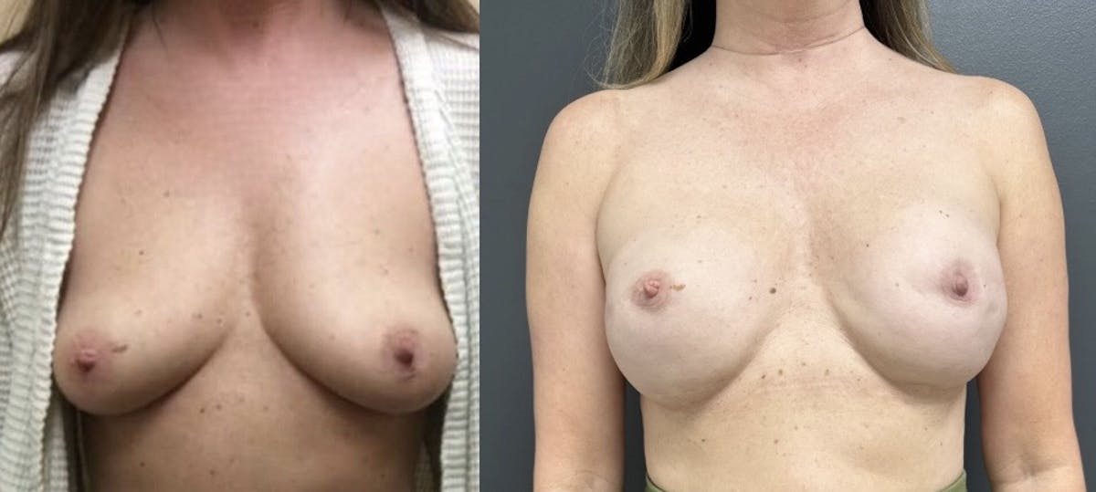 Breast Reconstruction Before & After Gallery - Patient 194435 - Image 1