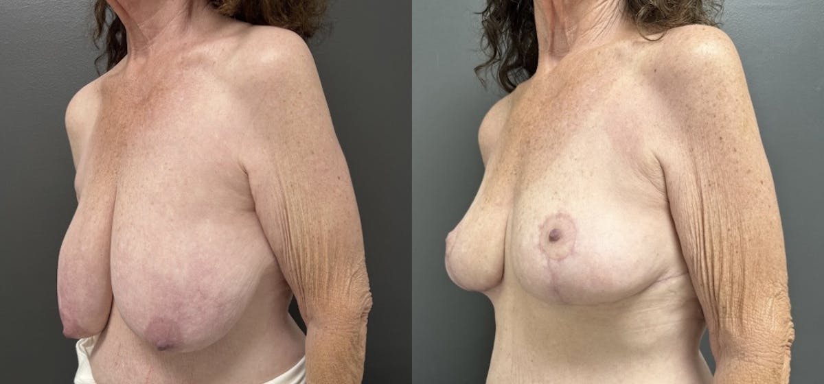 Breast Reduction Before & After Gallery - Patient 318065 - Image 2