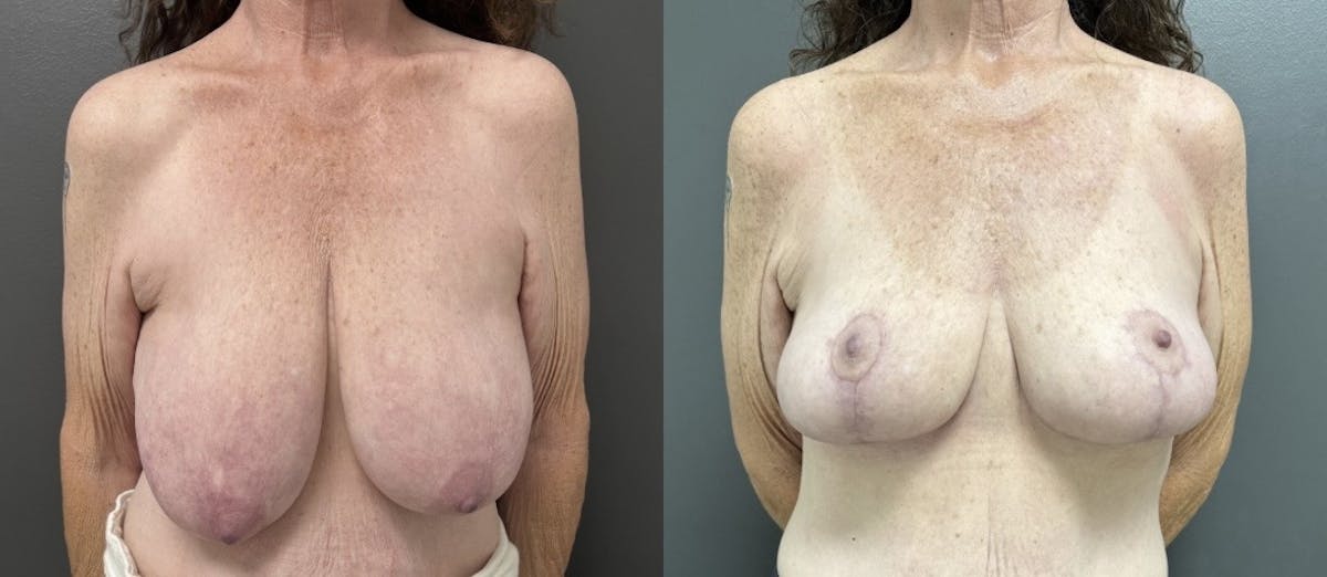 Breast Reduction Before & After Gallery - Patient 318065 - Image 1