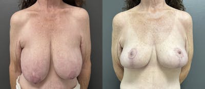 Breast Reduction Before & After Gallery - Patient 318065 - Image 1