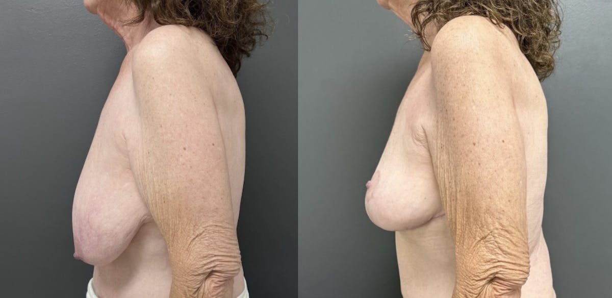 Breast Reduction Before & After Gallery - Patient 318065 - Image 3