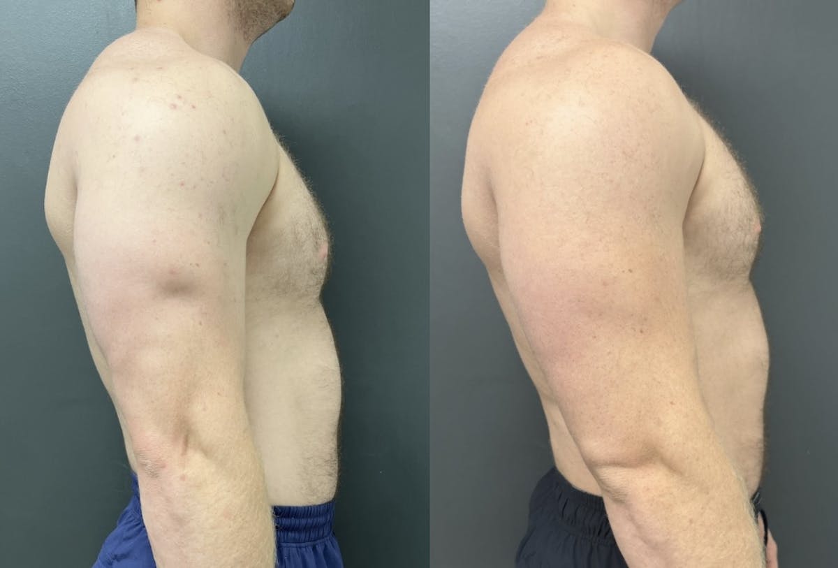 Gynecomastia Before & After Gallery - Patient 311493 - Image 3