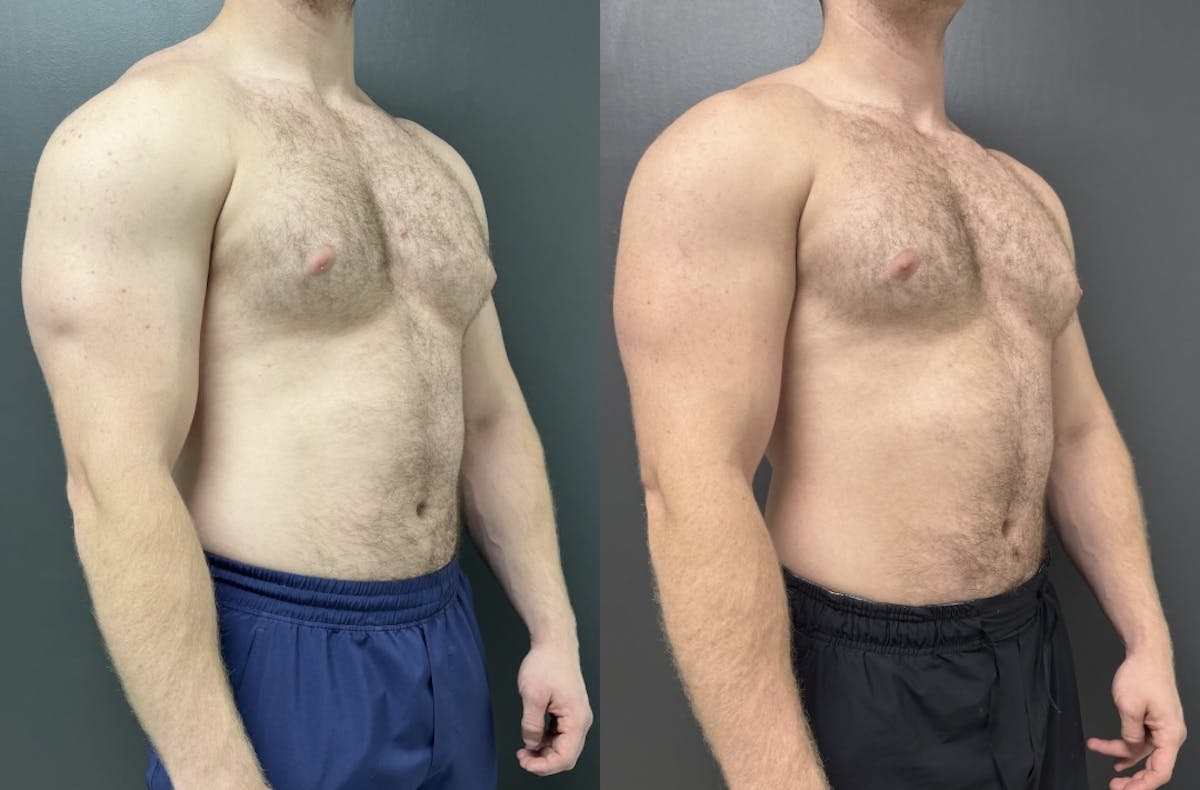 Gynecomastia Before & After Gallery - Patient 311493 - Image 2