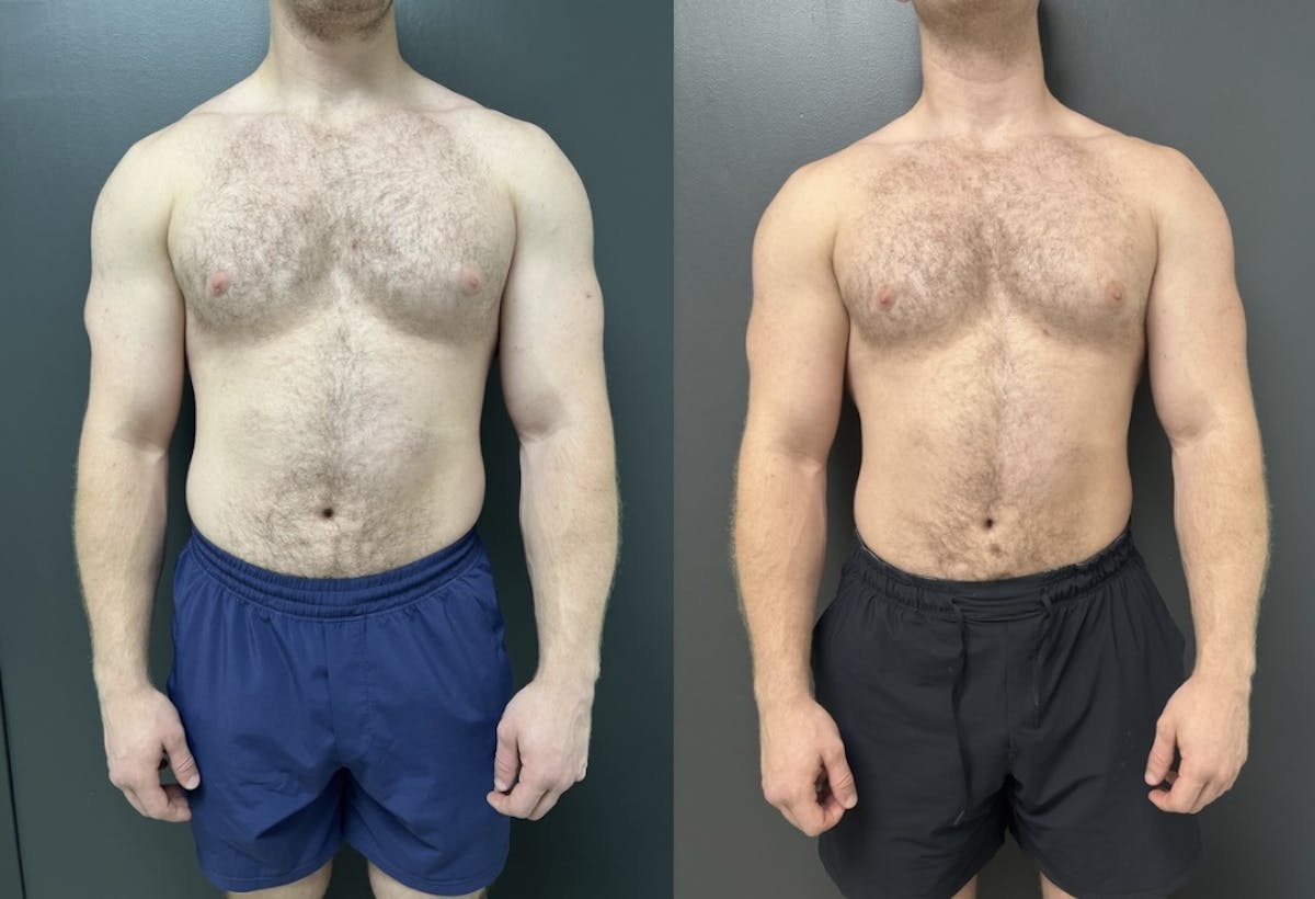 Gynecomastia Before & After Gallery - Patient 311493 - Image 1