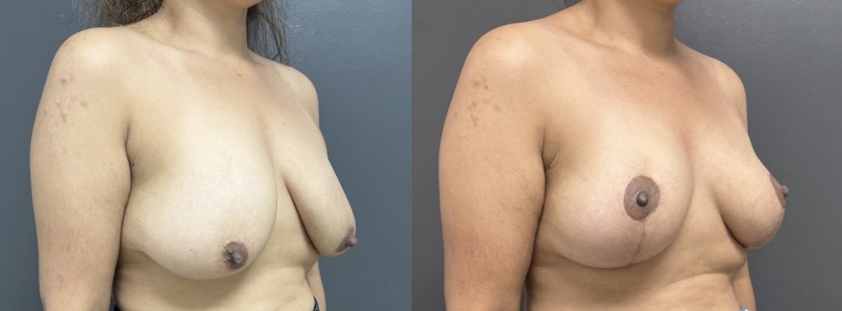 Mastopexy (Breast Lift) Before & After Gallery - Patient 318199 - Image 2