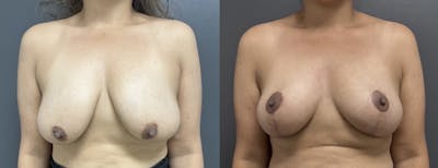 Mastopexy (Breast Lift) Before & After Gallery - Patient 318199 - Image 1