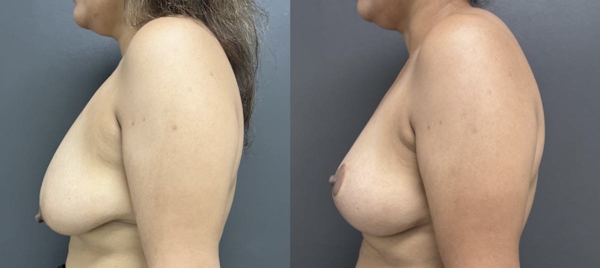 Mastopexy (Breast Lift) Before & After Gallery - Patient 318199 - Image 3