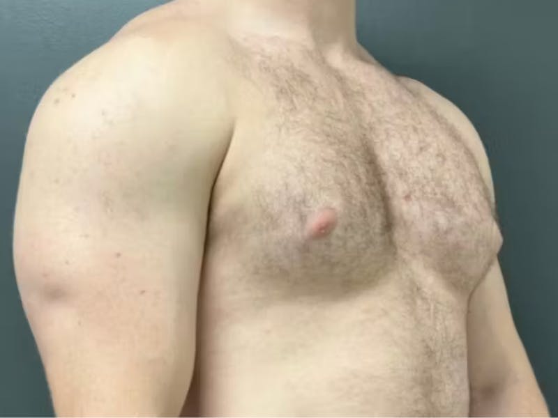 Gynecomastia Before & After Gallery - Patient 311493 - Image 3