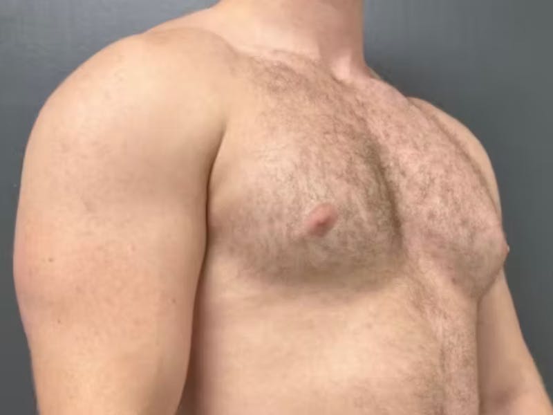 Gynecomastia Before & After Gallery - Patient 311493 - Image 4