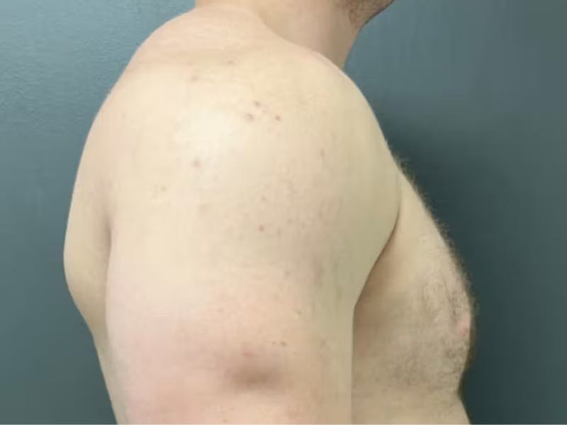 Gynecomastia Before & After Gallery - Patient 311493 - Image 5
