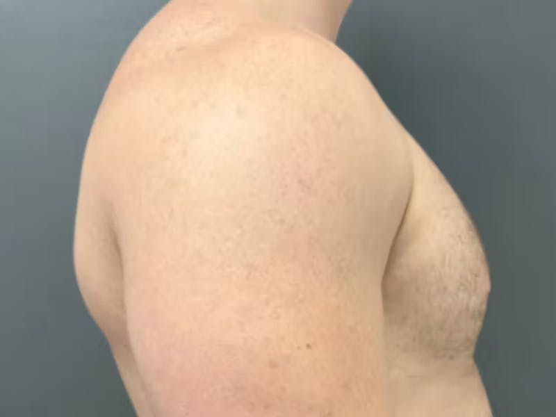 Gynecomastia Before & After Gallery - Patient 311493 - Image 6