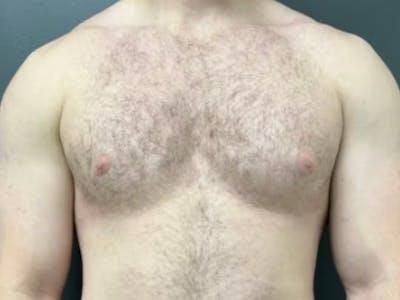 Gynecomastia Before & After Gallery - Patient 311493 - Image 1