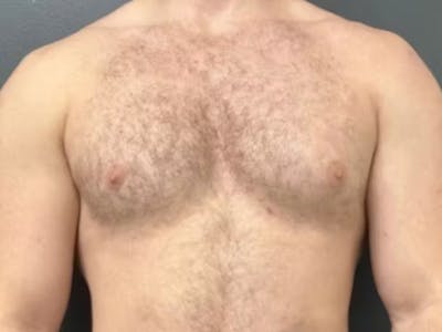 Gynecomastia Before & After Gallery - Patient 311493 - Image 2