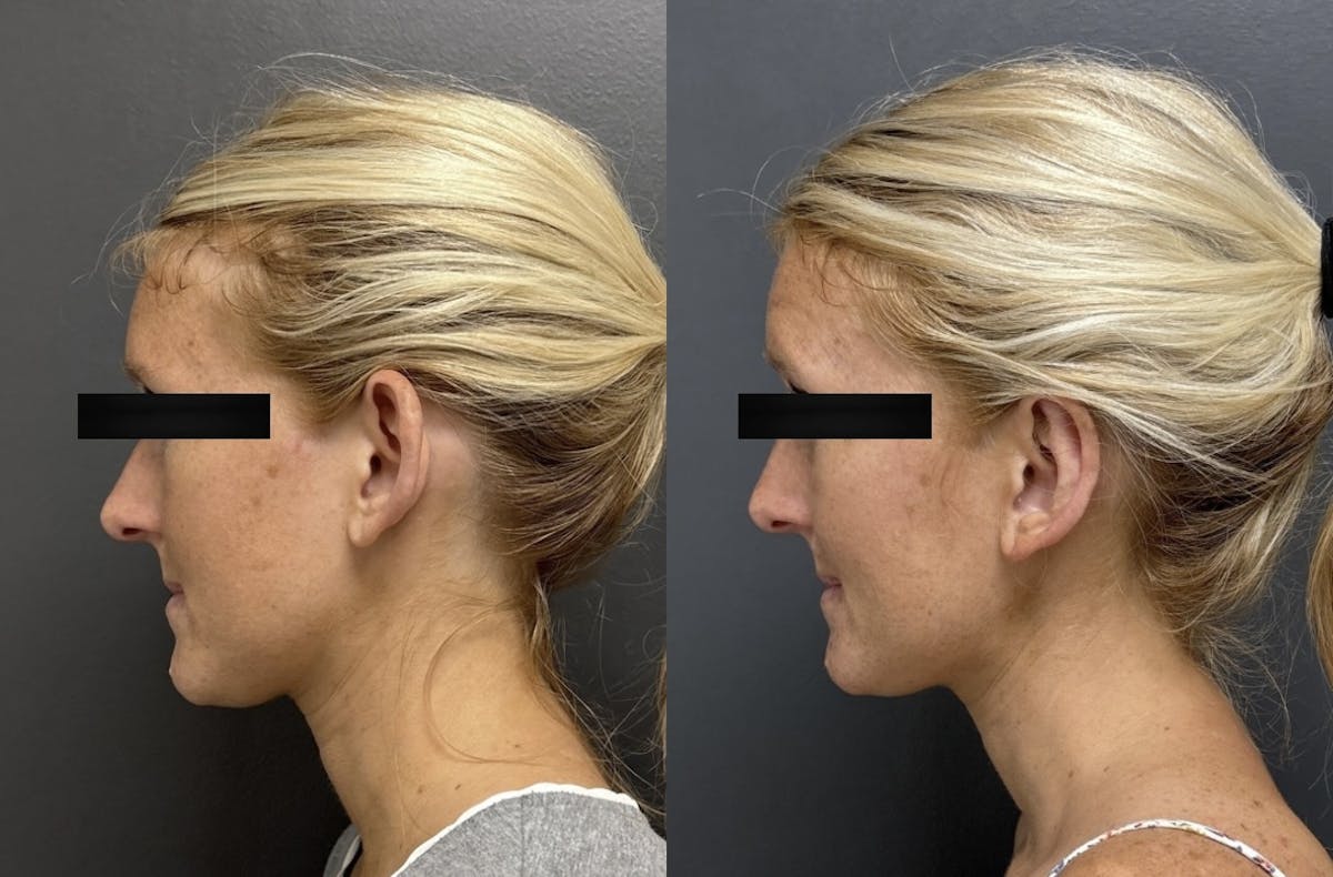 Earlobe Repair Before & After Gallery - Patient 142134 - Image 2