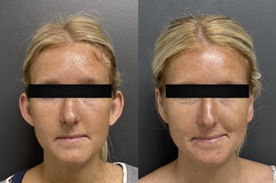 Earlobe Repair Before & After Gallery - Patient 142134 - Image 1