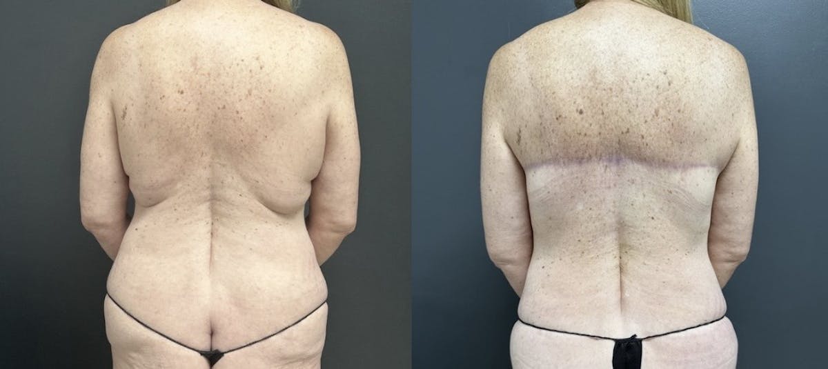 Back Lift Before & After Gallery - Patient 206273 - Image 1