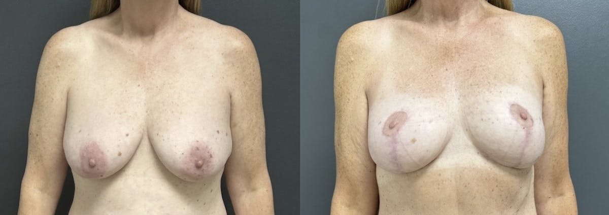 Mastopexy (Breast Lift) Before & After Gallery - Patient 281491 - Image 1