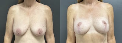 Mastopexy (Breast Lift) Before & After Gallery - Patient 281491 - Image 1