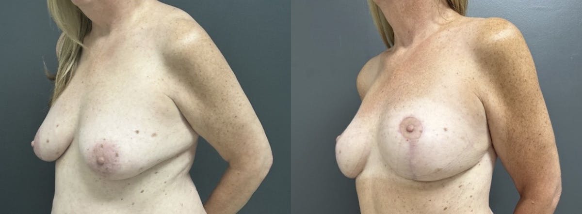 Mastopexy (Breast Lift) Before & After Gallery - Patient 281491 - Image 2