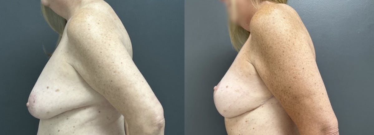 Mastopexy (Breast Lift) Before & After Gallery - Patient 281491 - Image 3
