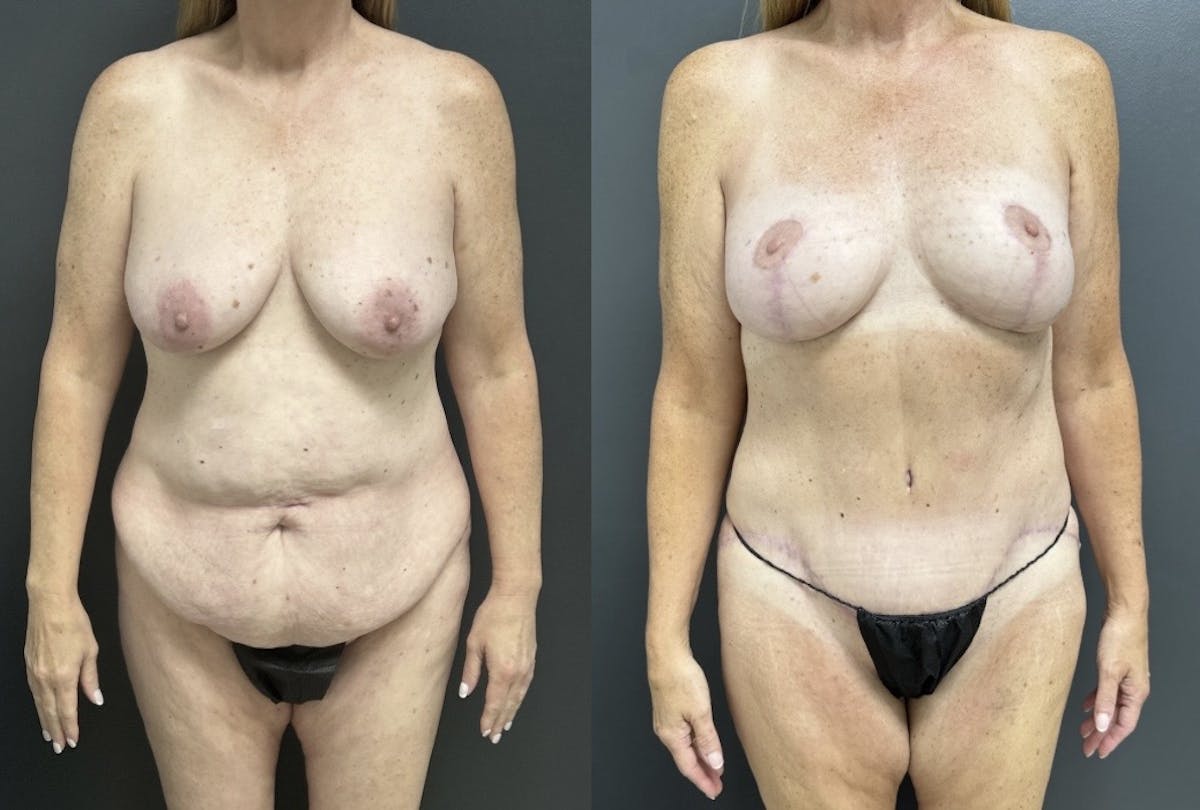 Abdominoplasty (Tummy Tuck) Before & After Gallery - Patient 344180 - Image 1